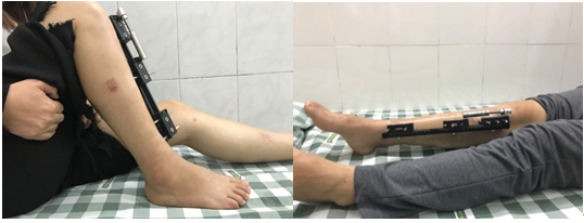 足踝日记 走路歪歪扭扭 俗称 长短脚 我们可以帮到你 广州中医药大学顺德医院 足踝日记 走路歪歪扭扭 俗称 长短脚 我们可以帮到你 广州中医药大学顺德医院
